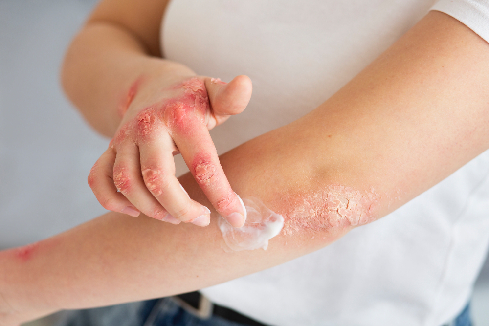 Bijengif wordt in de reguliere geneeskunde gebruikt bij diverse huidaandoeningen zoals eczeem en psoriasis. Minder bekende toepassingen van bijengif zijn te zien bij acne en littekens en bij wratjes.